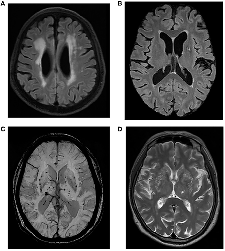 Frontiers | Type A personality, sleep quality, and cerebral