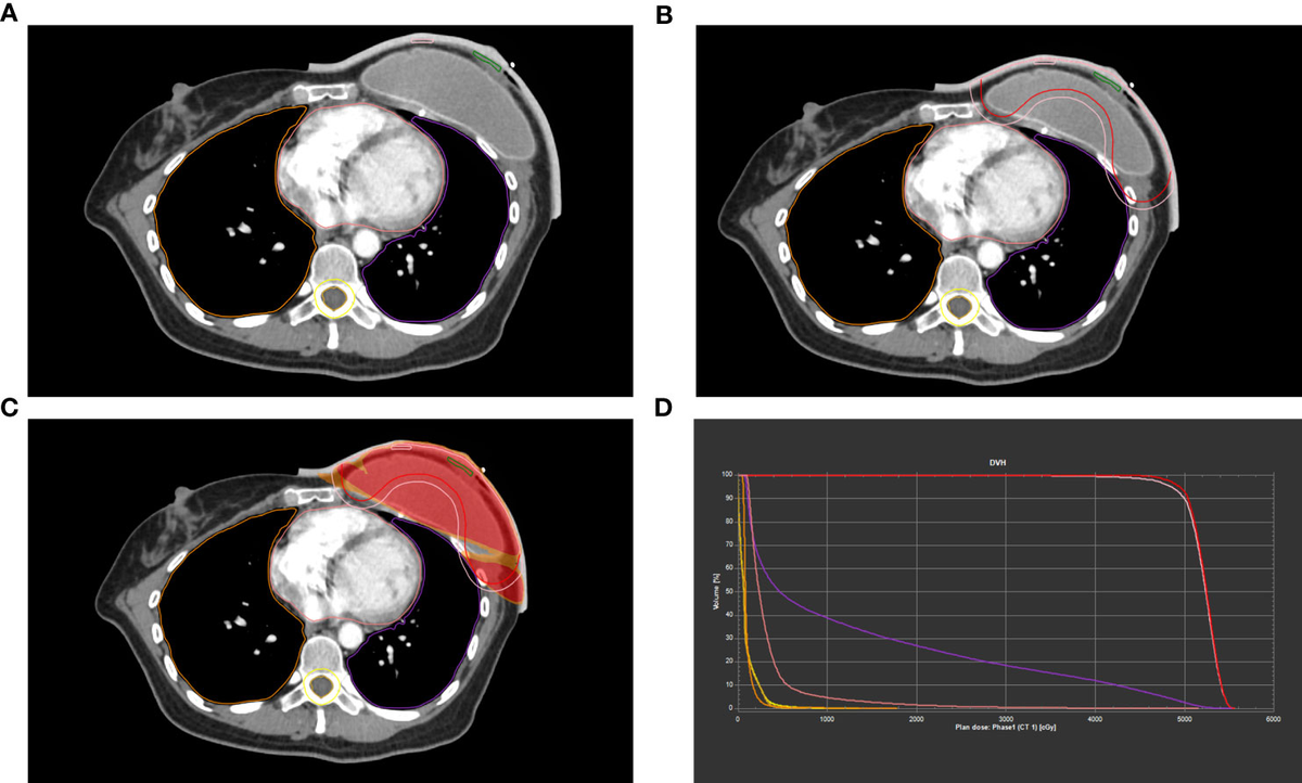 Frontiers | Individualized 3D-printed bolus promotes precise