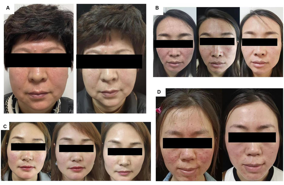 Frontiers | JAK1 inhibitor abrocitinib for the treatment of