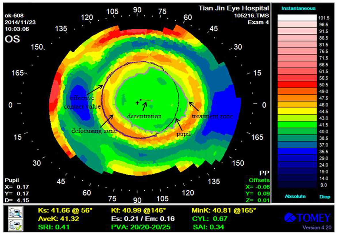 Frontiers | Evaluation of the corneal topography based on