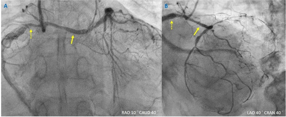 Percutaneous coronary intervention due to chronic total