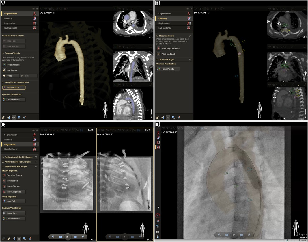 Frontiers | Multimodality 3D image fusion with live fluoroscopy reduces ...