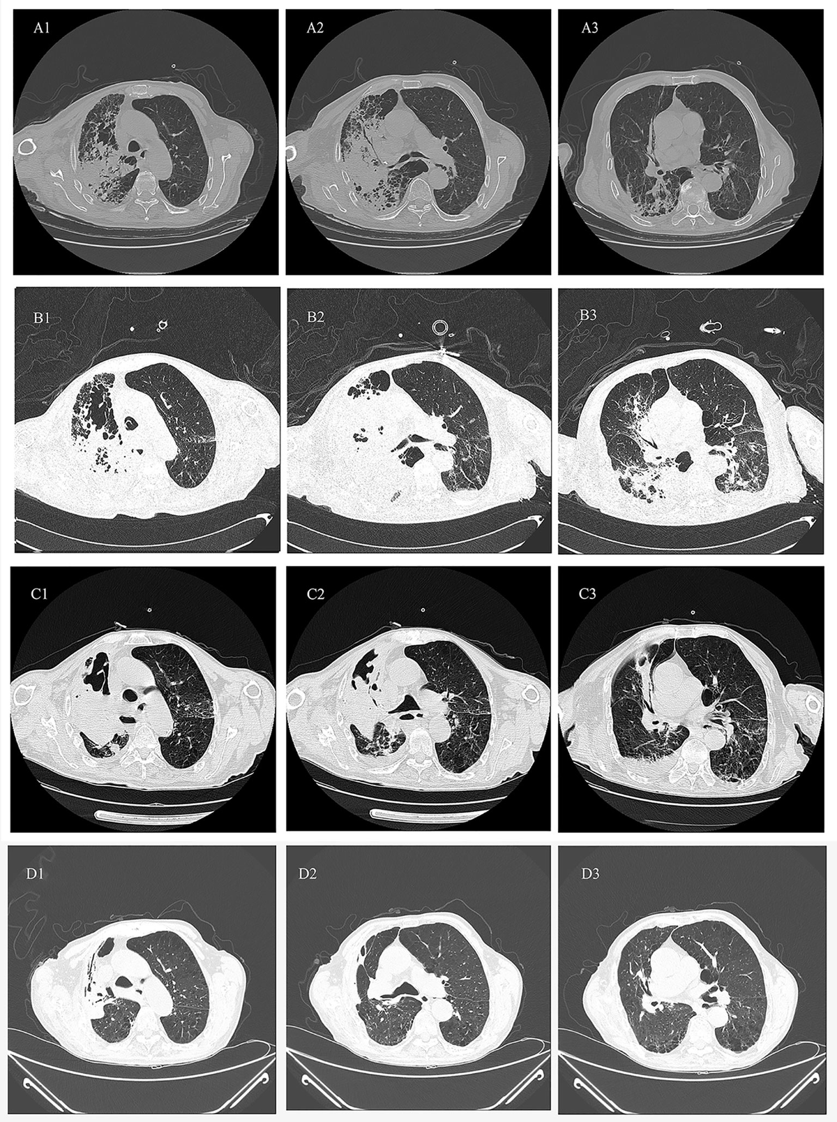 Frontiers | Streptomyces albireticuli lung infection managed
