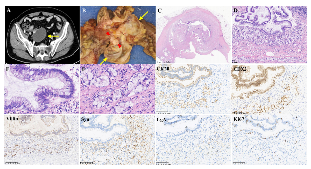Frontiers | Case report: A rare case of coexistence of low