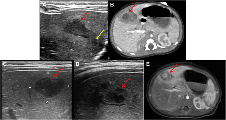 Frontiers | Point-of-care ultrasound in early diagnosis and