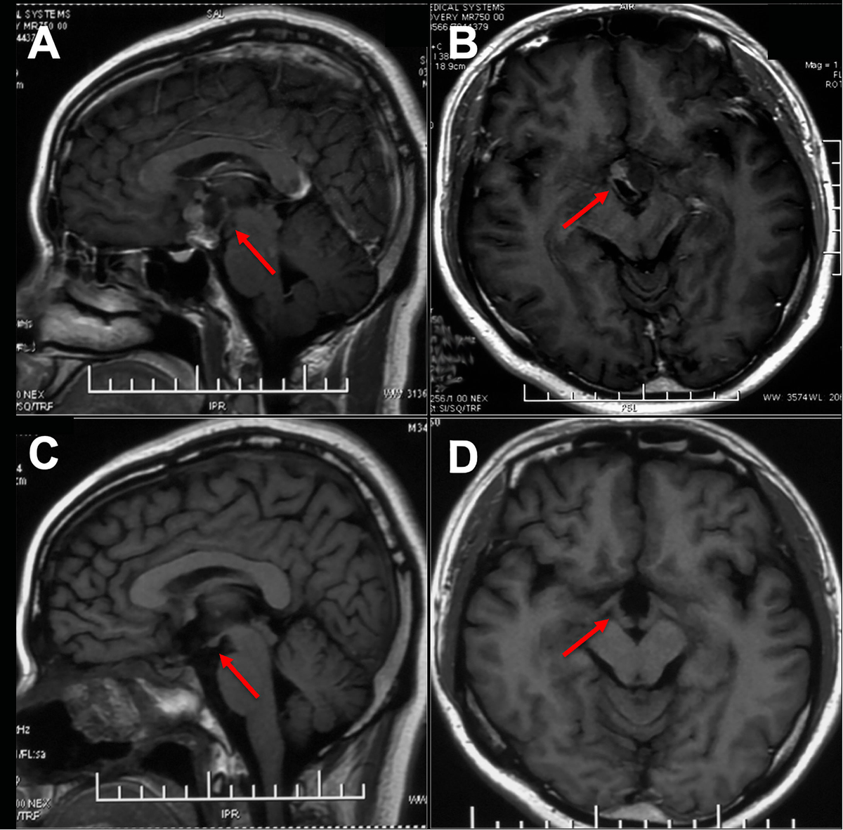 Frontiers | Advances in the treatment of Adamantinomatous