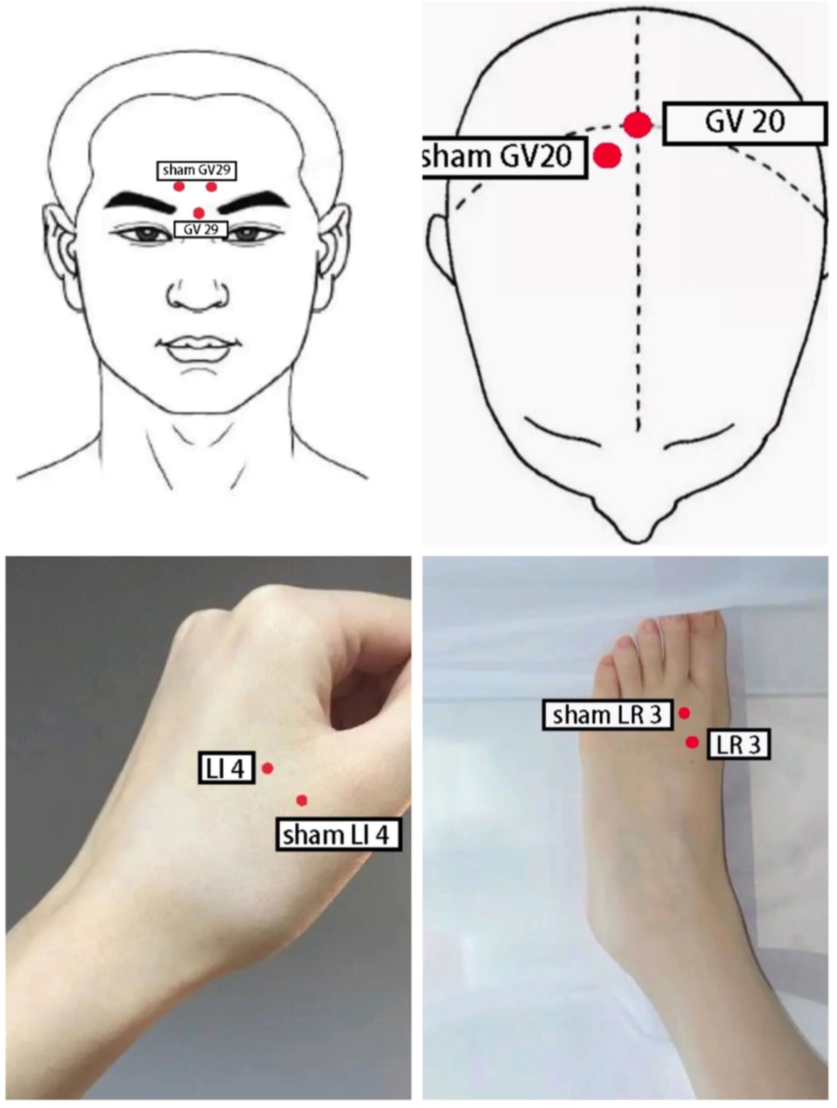 Frontiers | Electroacupuncture versus Escitalopram for mild