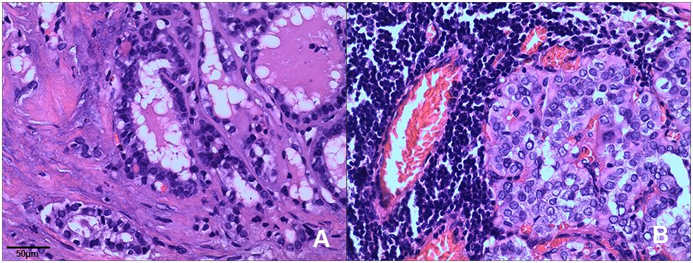 Frontiers | Clinicopathological features of two cases of