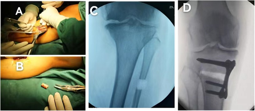 Frontiers | A new technique of autologous bone grafting for