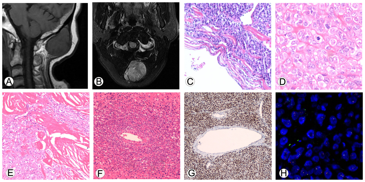 Frontiers Case report A rare case of malignant solitary fibrous tumor in an adult with an