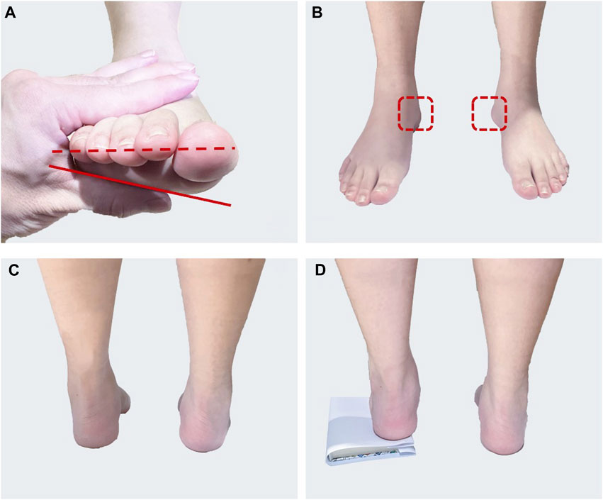 Pes cavus insoles sale