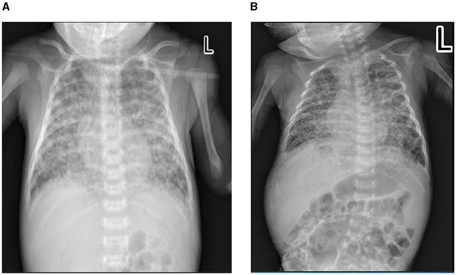 Frontiers | Case report: Congenital multidrug-resistant