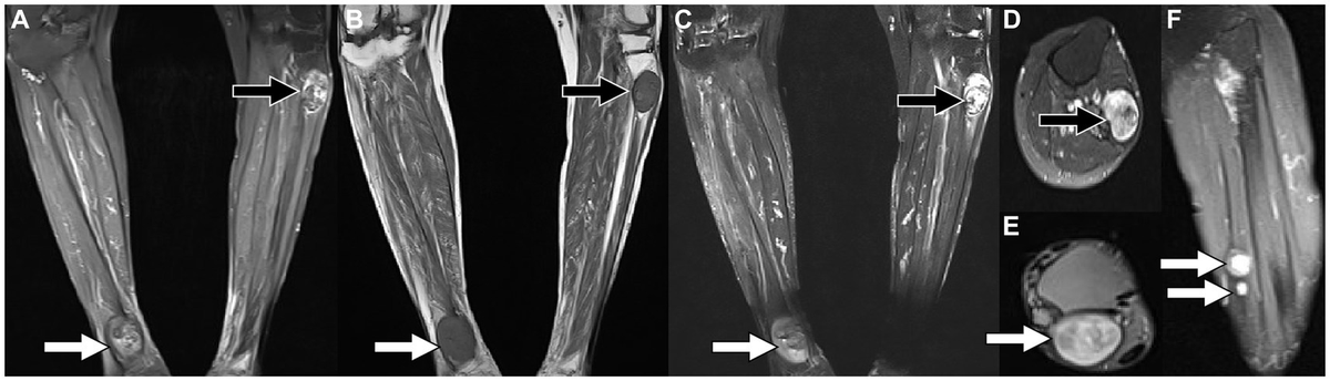 Frontiers | 18F-FDG PET/CT revealed sporadic schwannomatosis