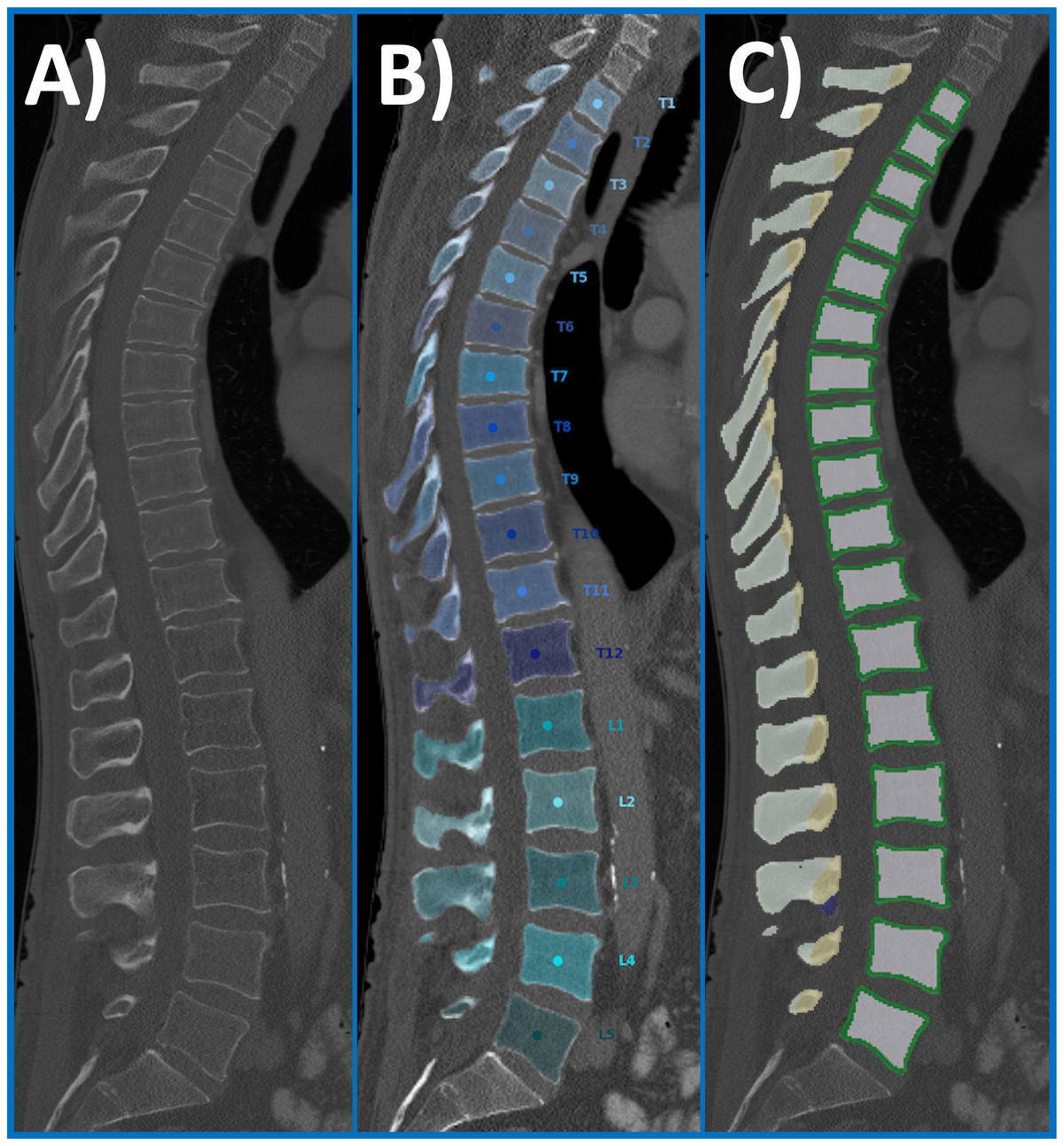 Spinal cord injury – basic principles and management