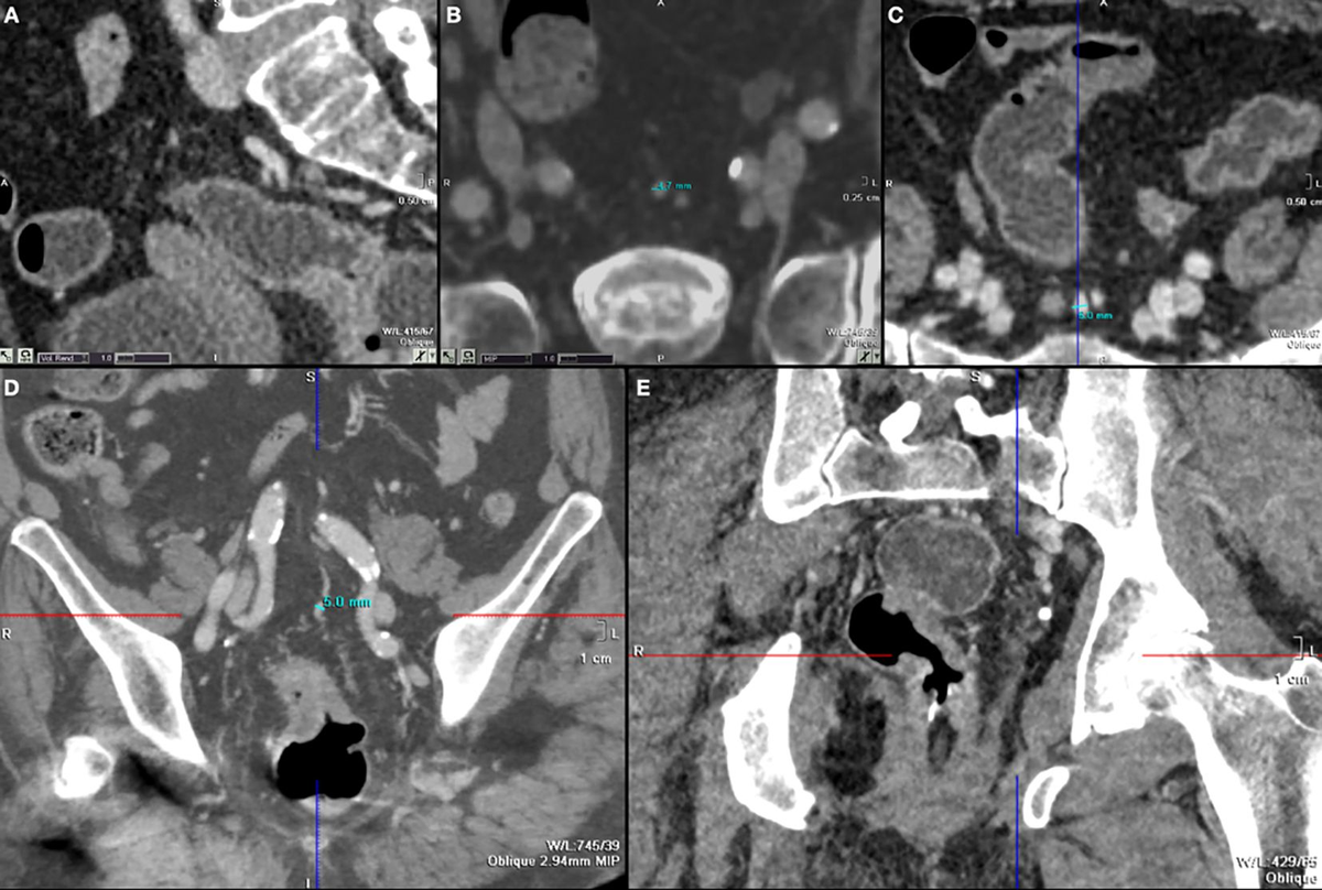 Frontiers | The role of superior hemorrhoidal vein ectasia in the  preoperative staging of rectal cancer, image size:1200x808