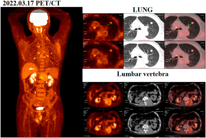 Frontiers | QL1604 combined with bevacizumab as an