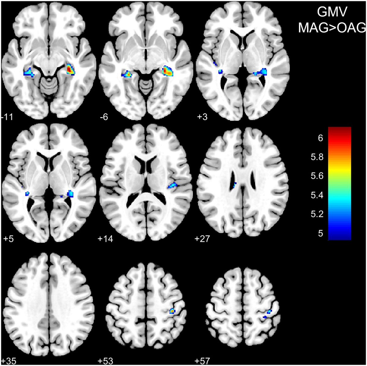 Frontiers | Comparison between morphometry and radiomics