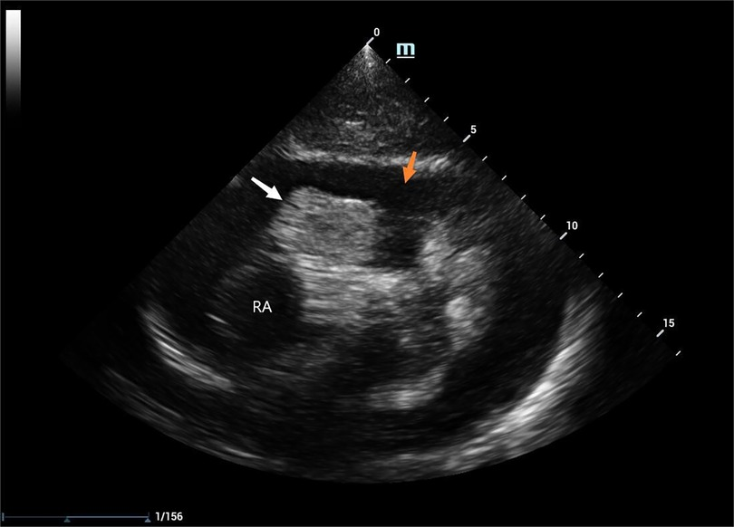 Frontiers | Case report of a ruptured right atrial aneurysm