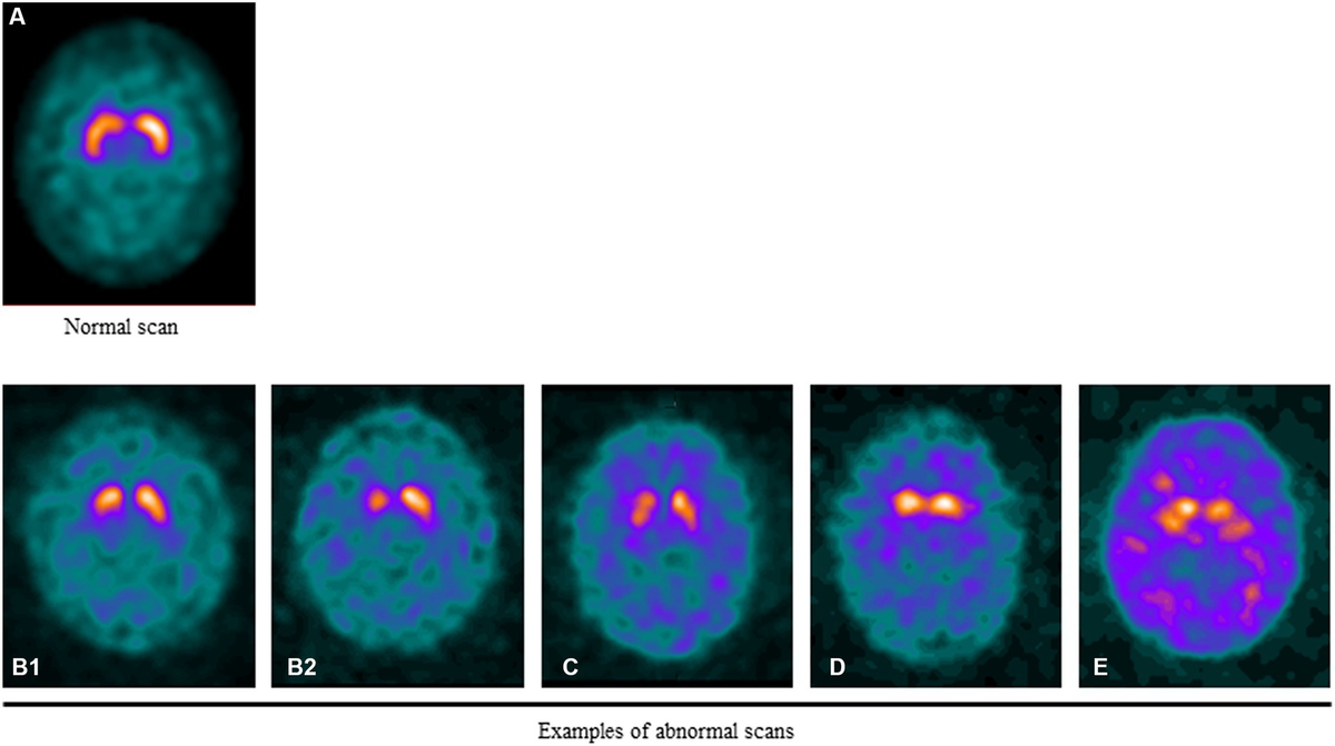 Frontiers | Practical use of DAT SPECT imaging in diagnosing 