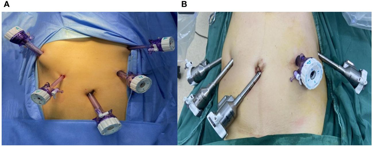 【裁断済み】外傷形成外科 Emergency Plastic Surgery Orbital Blowout Fracture: Position of Orbital Plate After