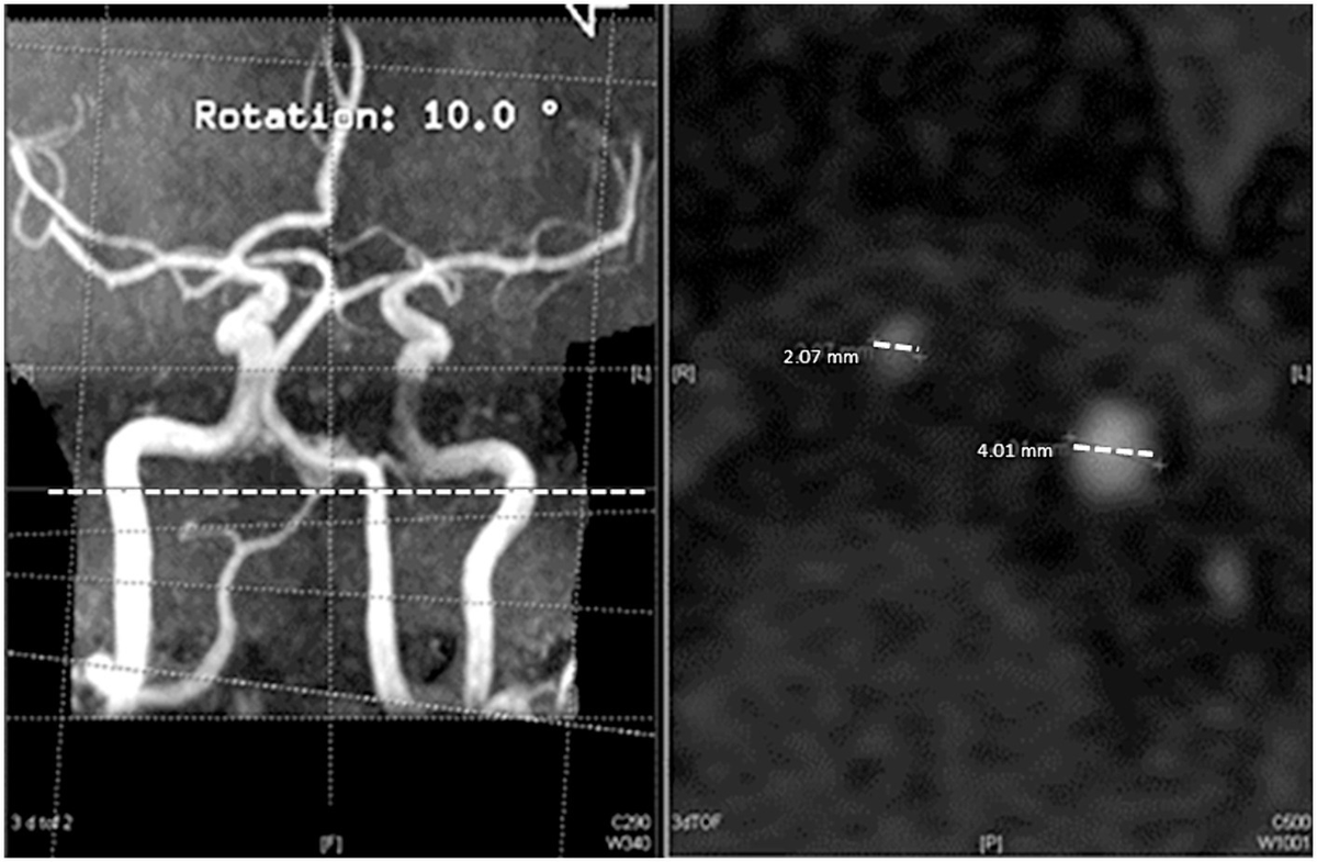 Right, Sagittal, and Inferior Cerebral Artery Territories