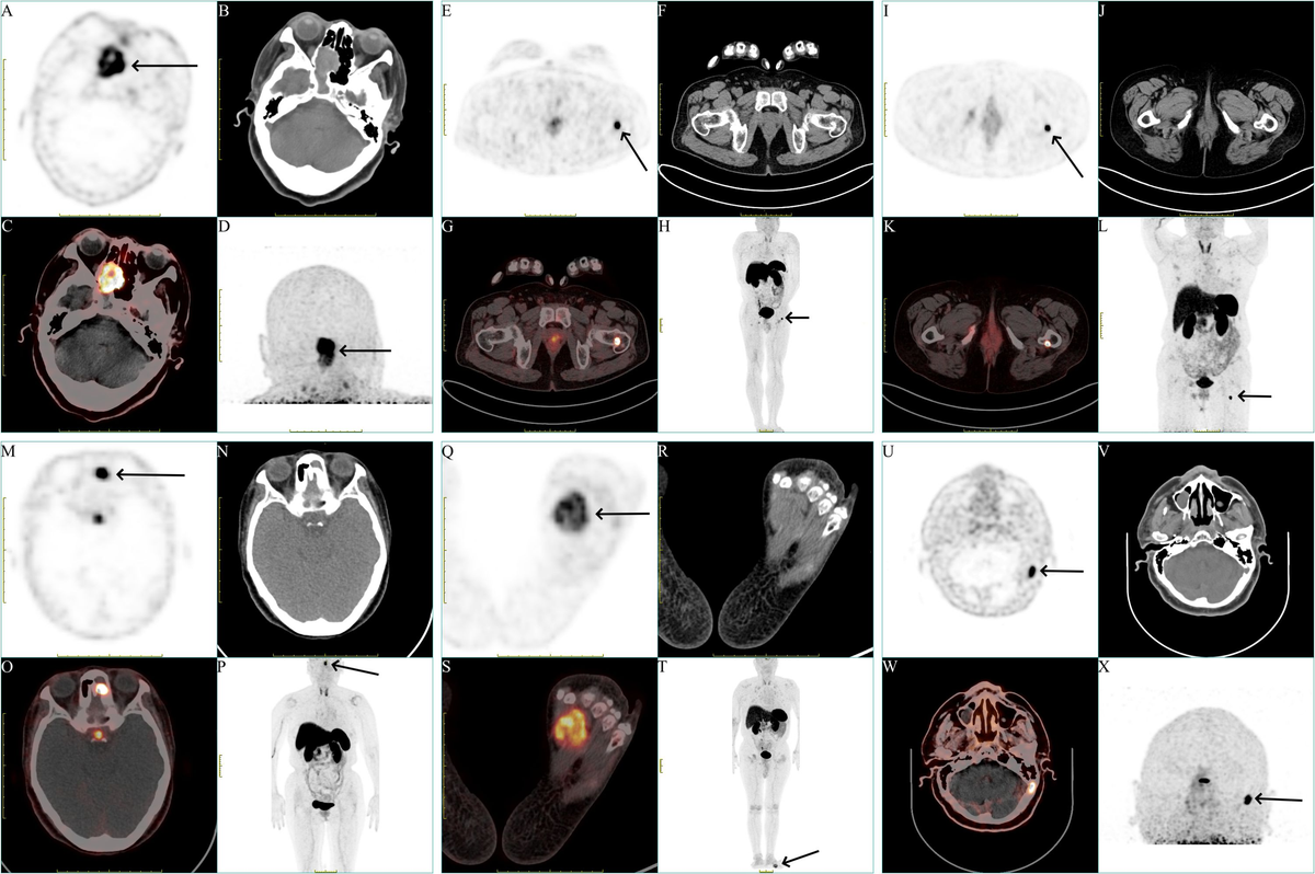 Frontiers | 18F-AlF-NOTA-octreotide PET/CT in the localization of tumor ...