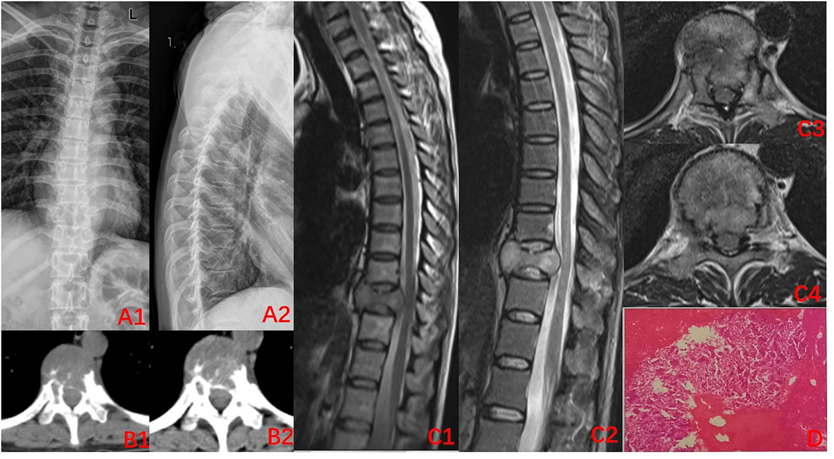 Frontiers | Denosumab combined with microwave ablation