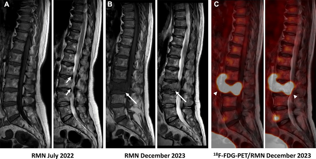 健康・医学 Cancer in the spine Spinal Cancer: What You Should Know