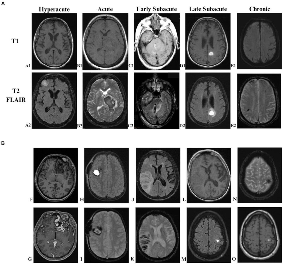 New Insights in Intracerebral Hemorrhage (ISSN Book 37