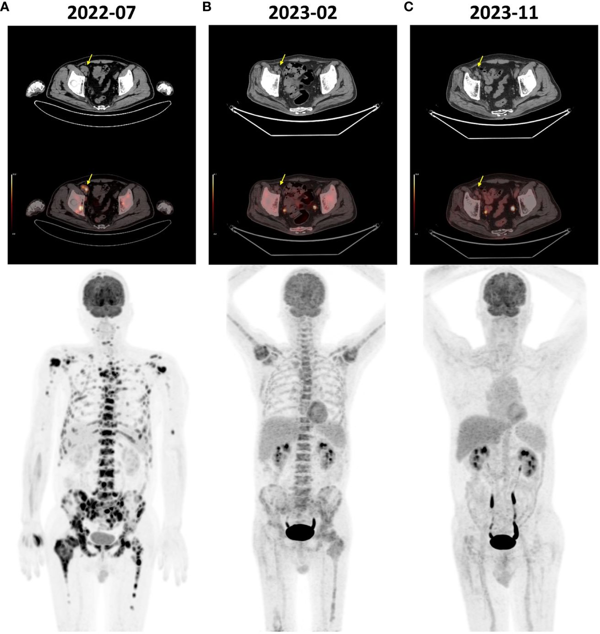 Frontiers | Case report: Immunotherapy-based combination