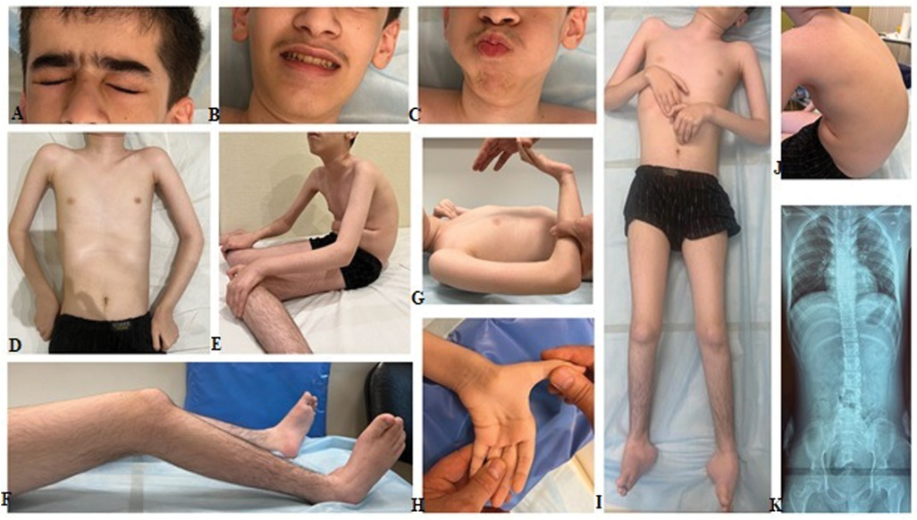 Frontiers | Case Report: Exploring the clinical spectrum of