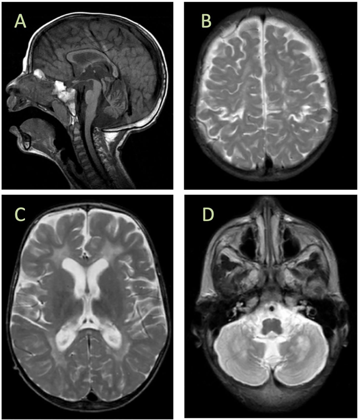 Spinal cord involvement and paroxysmal events in “Infantile