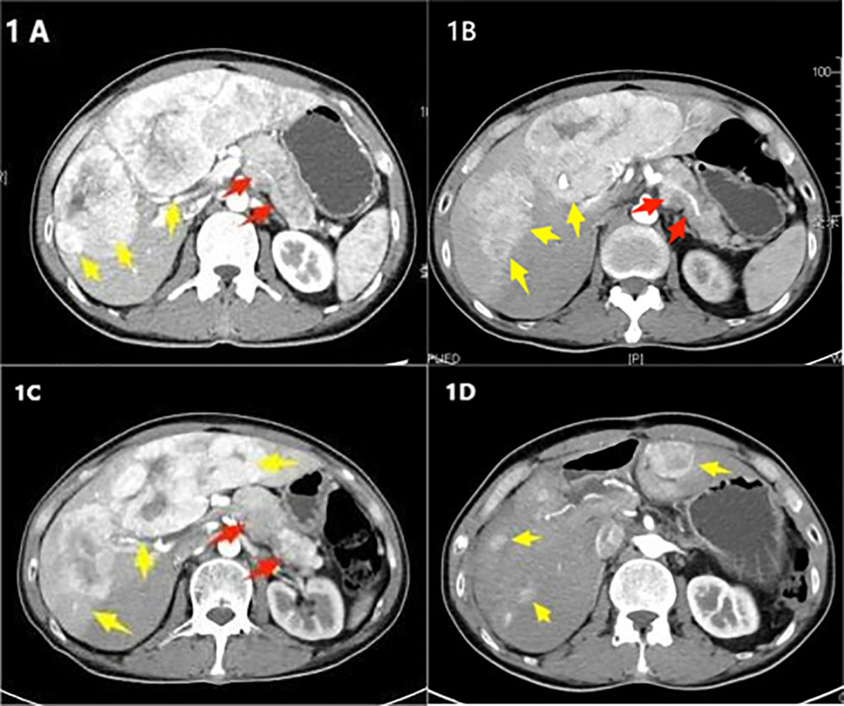 Frontiers | Case report: Surgical treatment and literature
