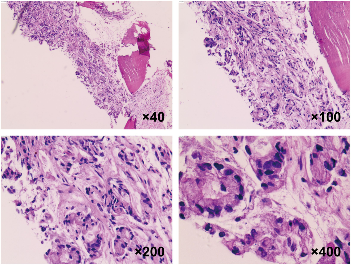 その他 thus Brown Adipose Tissue and BMP3b Decrease Injury in Cardiac