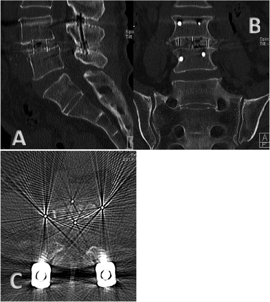 Frontiers | Risk factors for low back pain after oblique