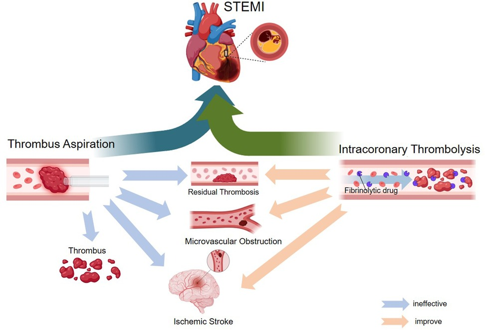 Frontiers | Enhancing microcirculation in STEMI patients
