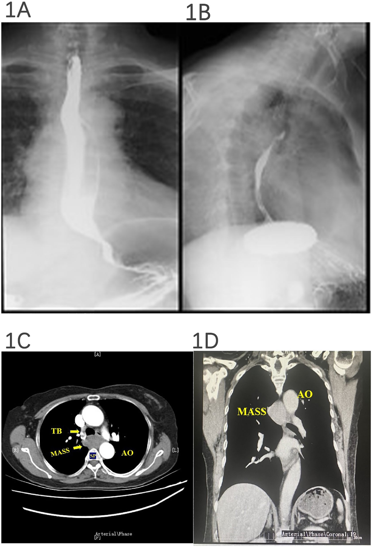 Frontiers | Case Report: An azygos vein aneurysm with