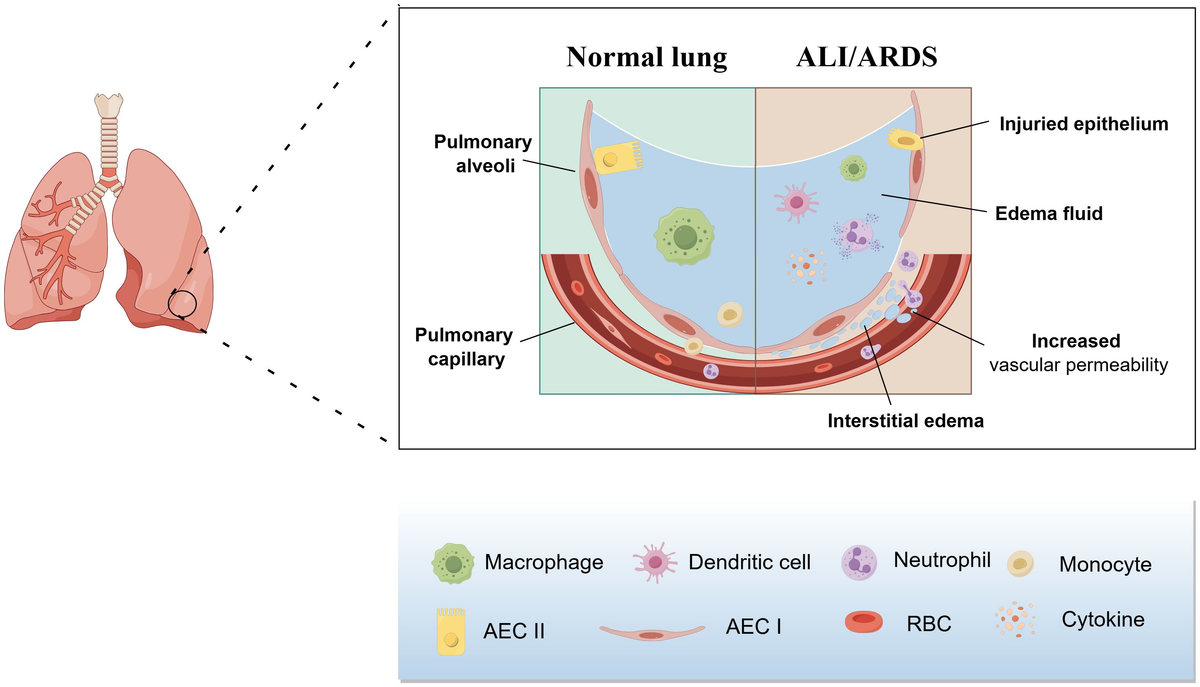 Frontiers | Macrophage pyroptosis and its crucial role in ALI/ARDS