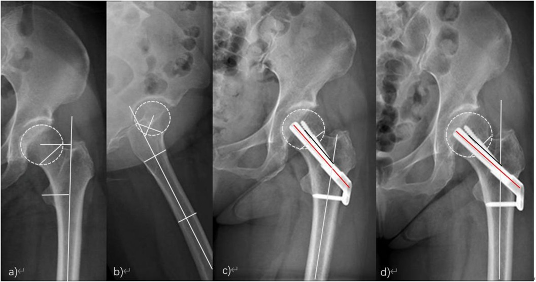 Frontiers | A short-term efficacy comparison between the FNS