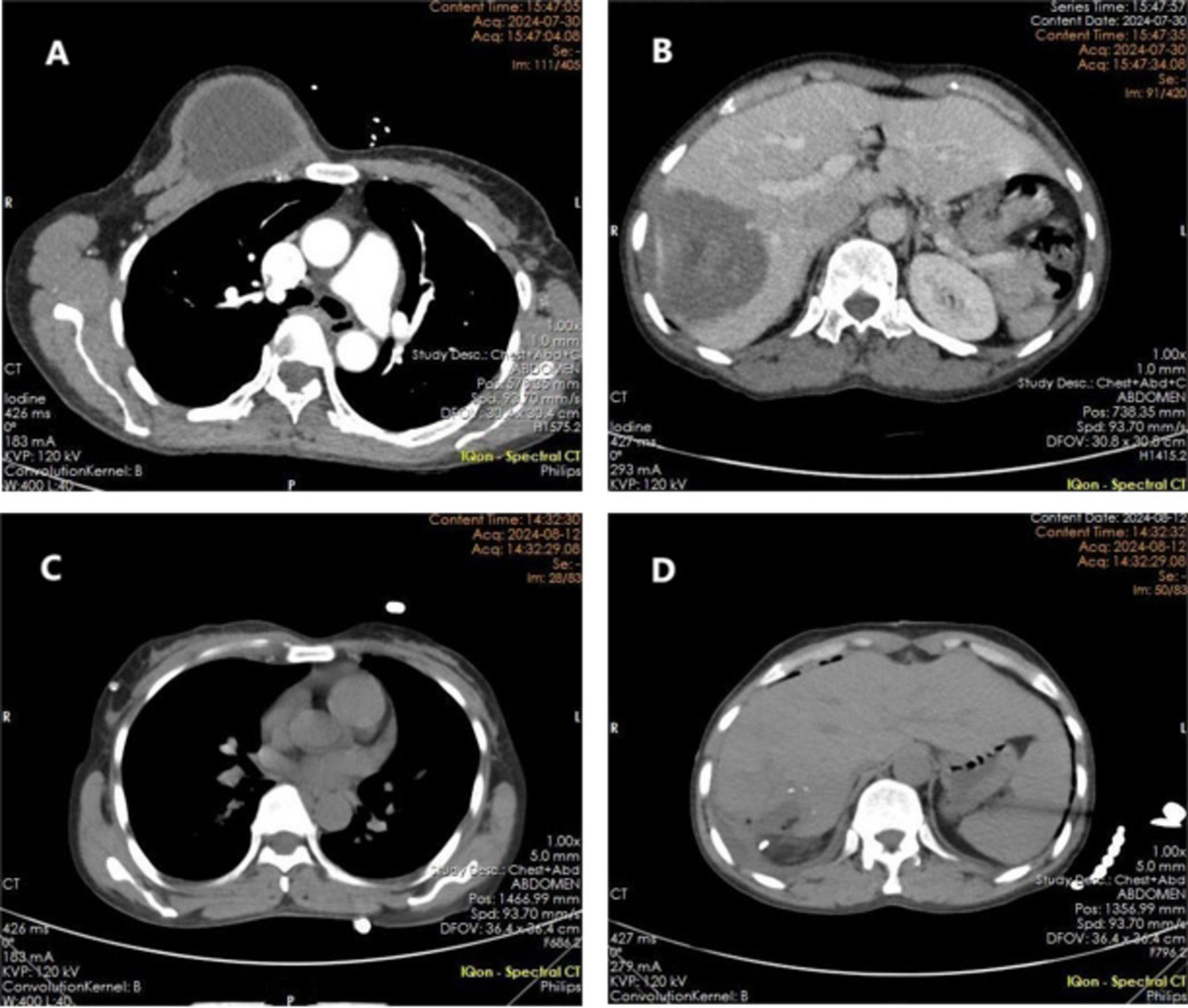 Frontiers | Hepatic alveolar echinococcosis with chest wall