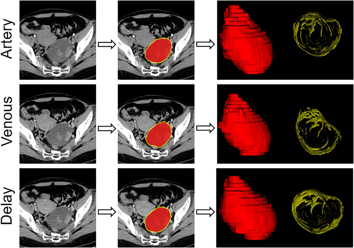 Frontiers | Preoperative prediction of lymph node metastasis