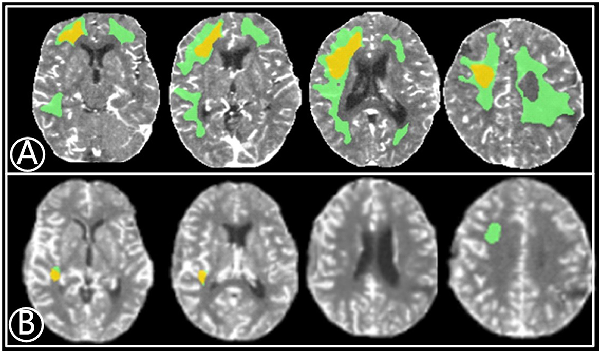 Frontiers | Cognitive outcomes after extracranial