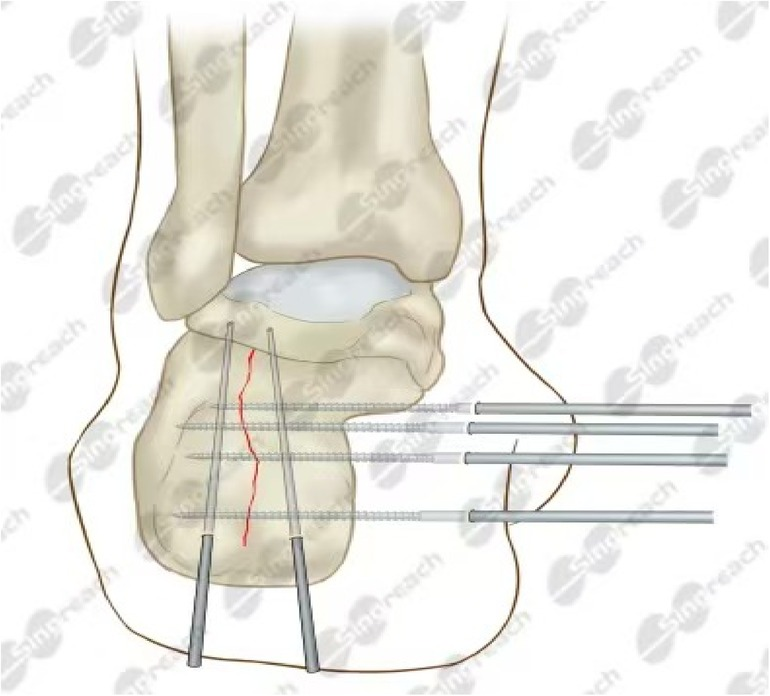 Associations between condylar height relative to occlusal