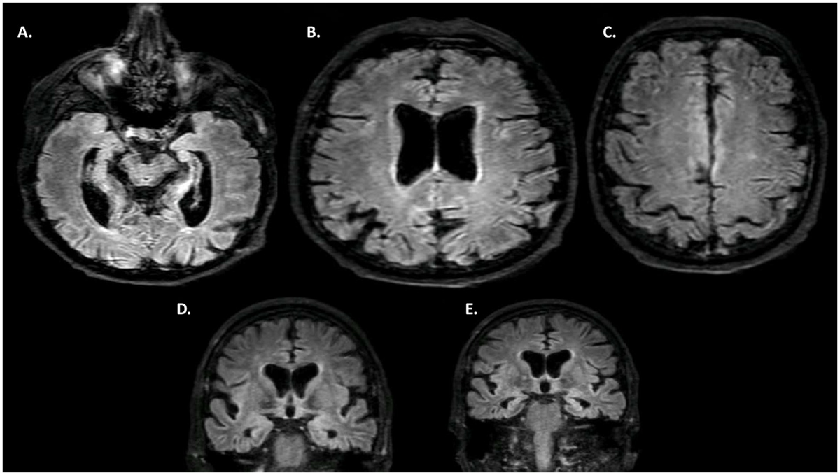 Frontiers | Alice in Wonderland Syndrome in dementia with