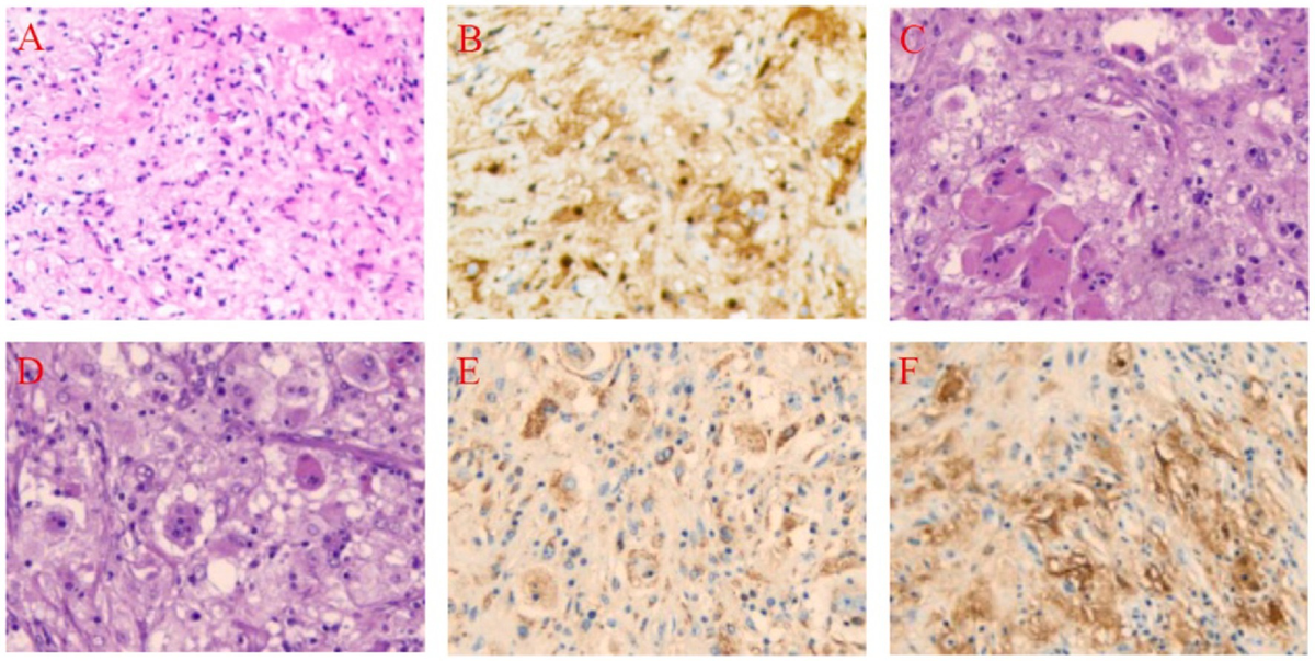 Frontiers | Case report: Primary subcutaneous Rosai-Dorfman