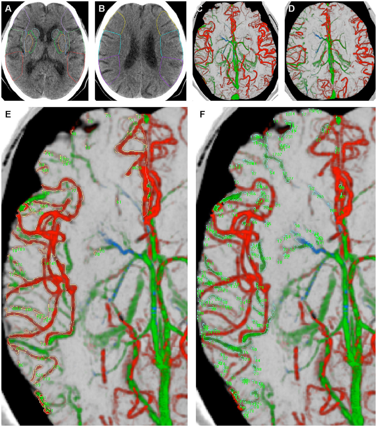 Frontiers | Quantitative insights into stroke recovery
