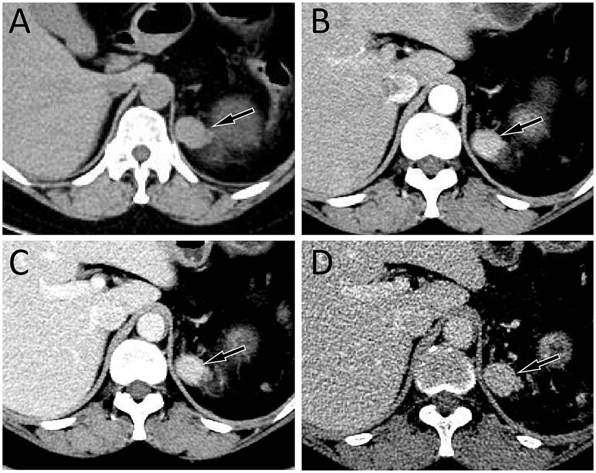Frontiers | Case Report: Adrenal gland splenosis mimicking a