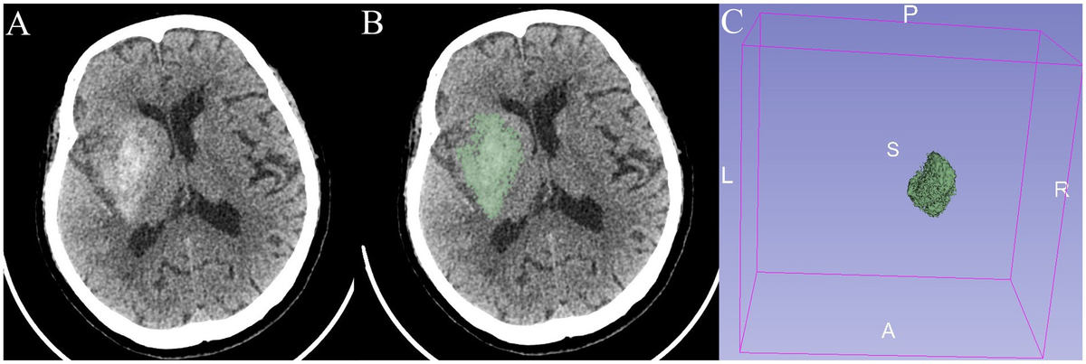 Frontiers | Quantitative contrast enhancement volume on immediate