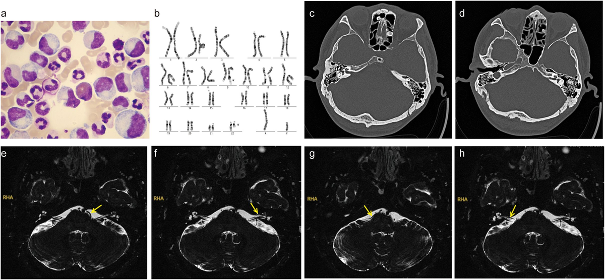 Frontiers Unilateral sudden hearing loss as the first presenting
