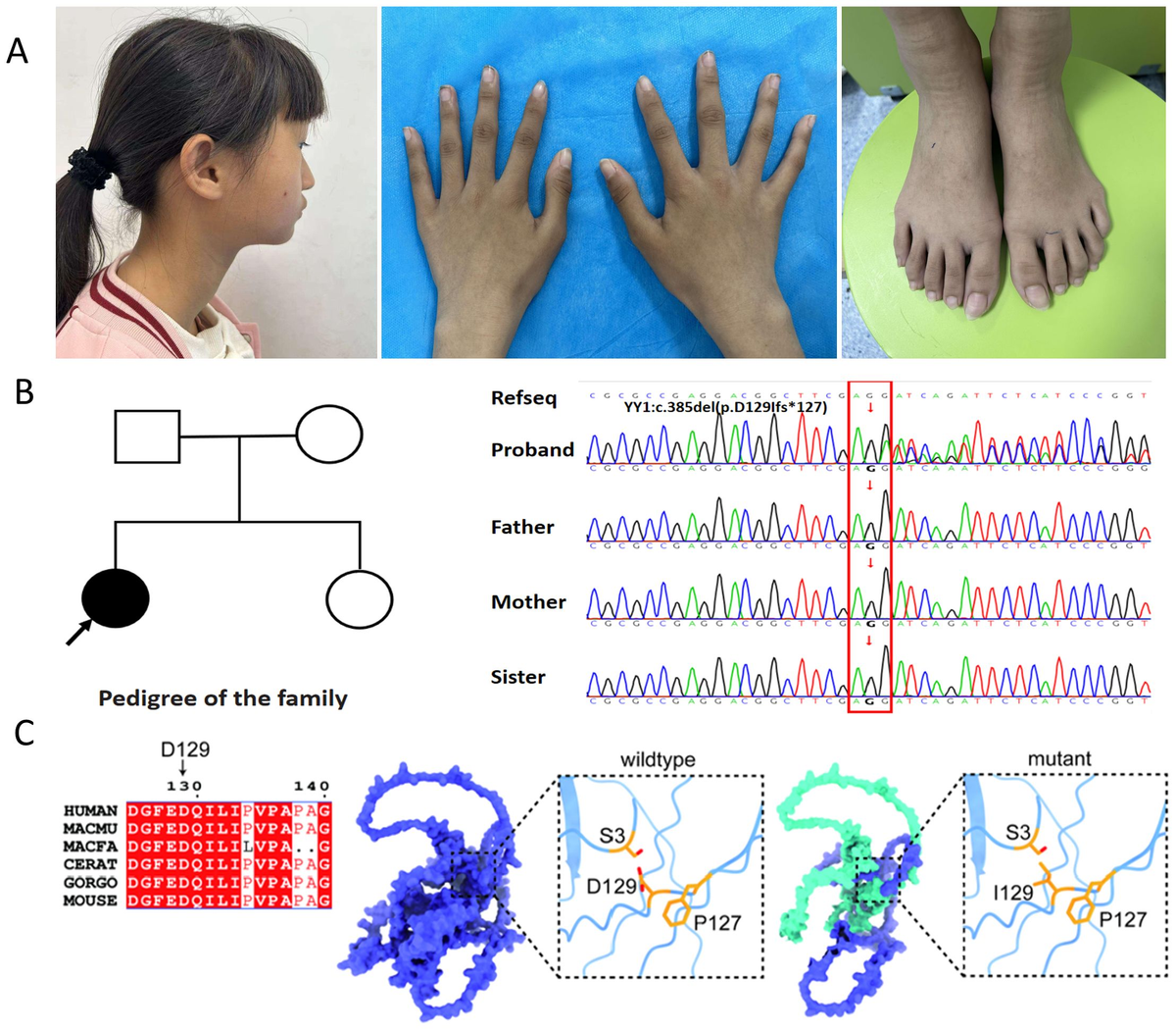 その他 E. Frontiers | Hashimoto's thyroiditis and nanophthalmos in